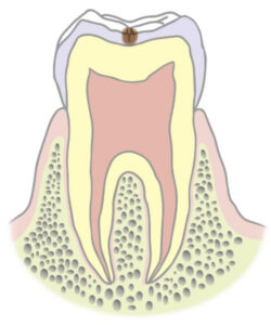 C0（むし歯の前段階）