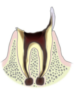 C4（むし歯が進行し根っこだけになった状態）​