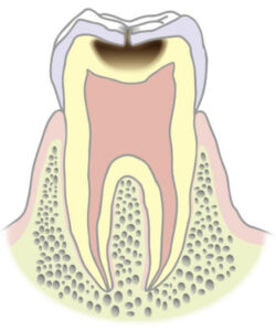 C2（象牙質のむし歯）