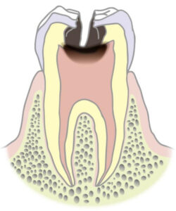C3（歯髄まで進行したむし歯）​