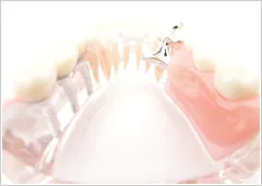 きわめて安全に装着できる、当院のインプラント